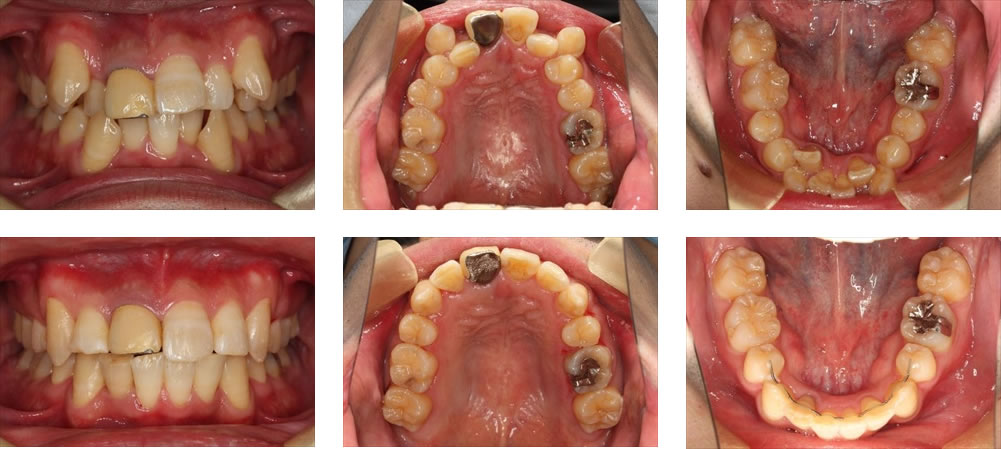 八重歯・叢生の治療例