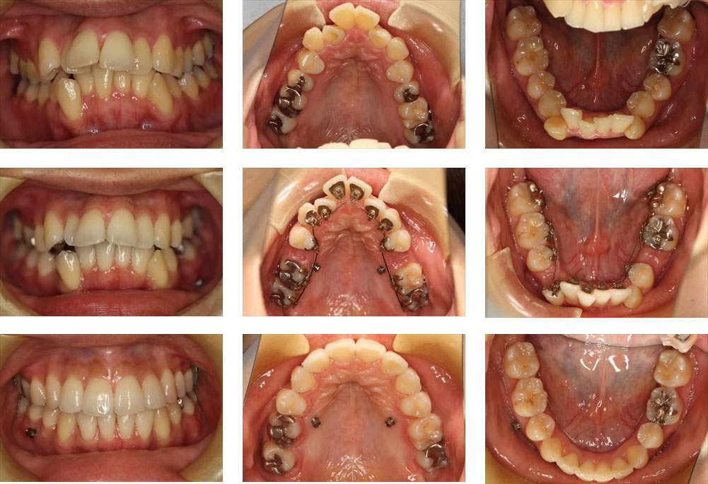 八重歯・叢生の治療例