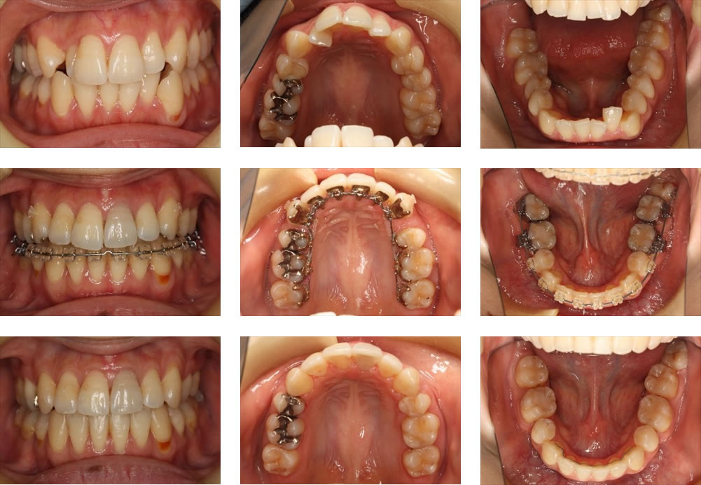 八重歯・叢生の治療例