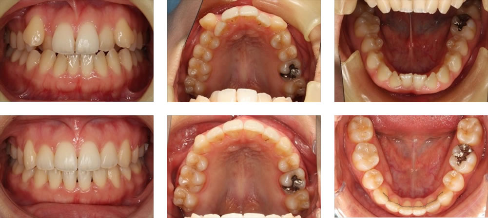 八重歯・叢生の治療例