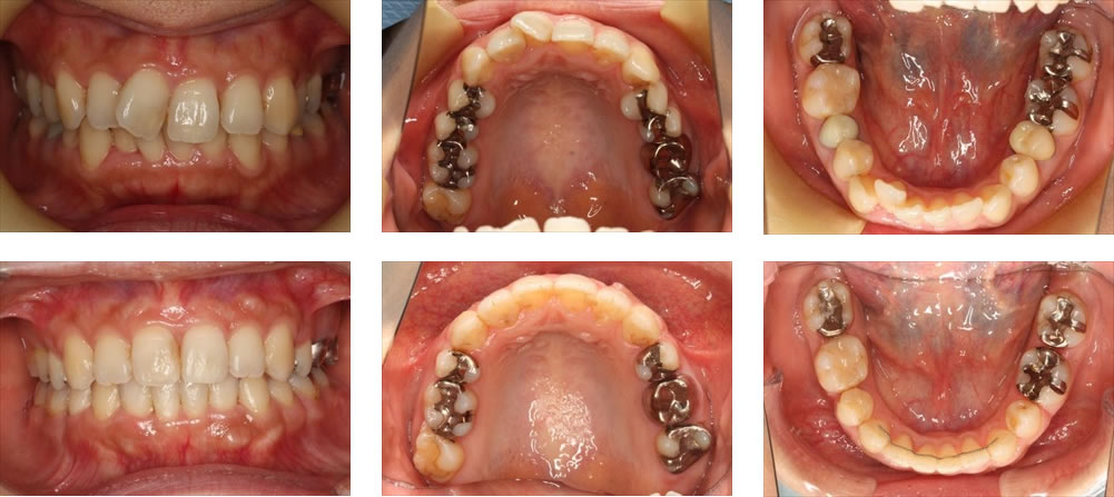 八重歯・叢生の治療例