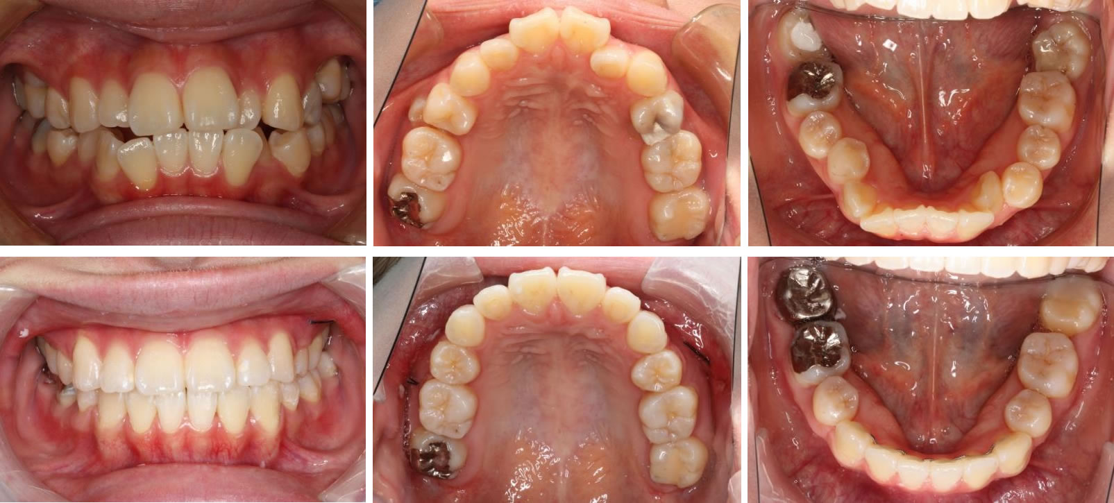 八重歯・叢生の治療例