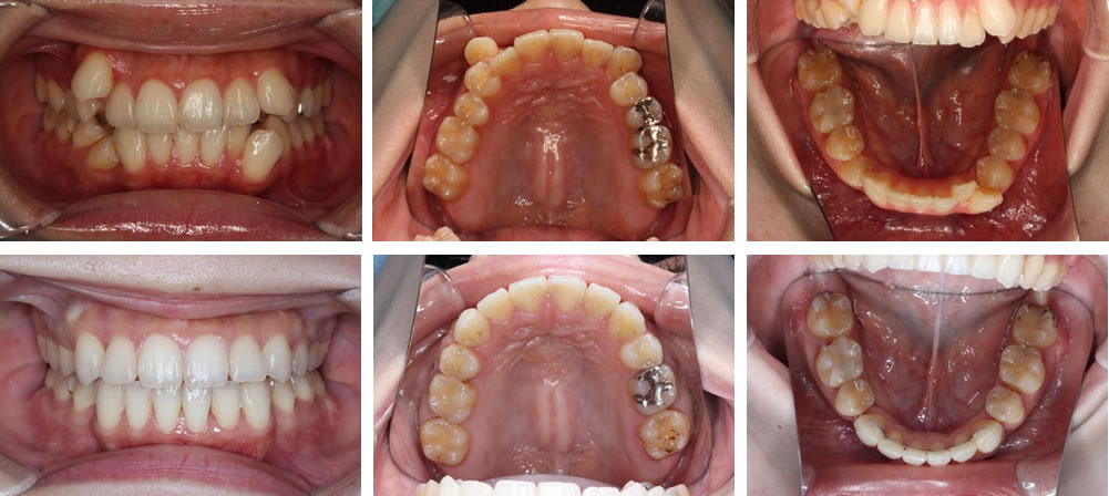 八重歯・叢生の矯正治療例（20代女性 治療期間2年1ヶ月）