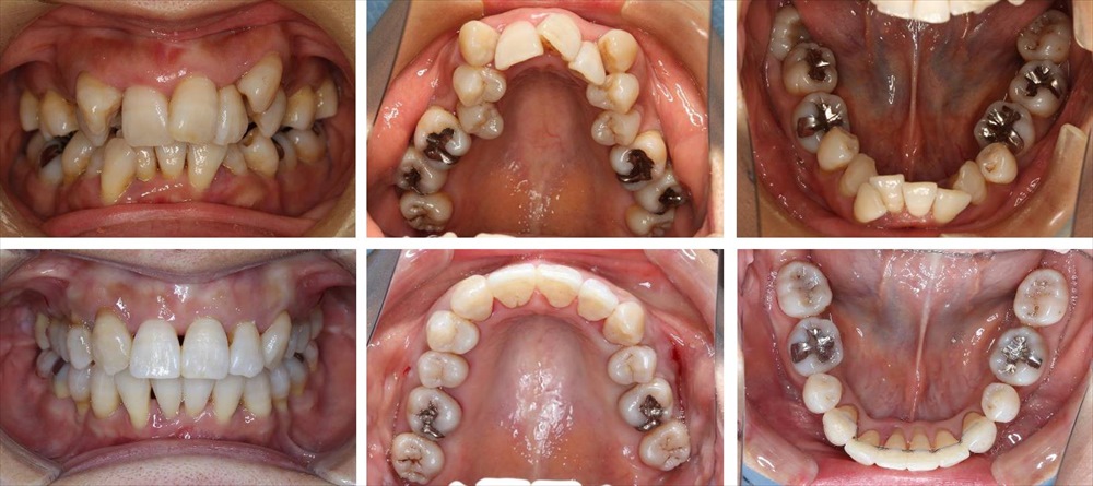 八重歯・叢生の治療例