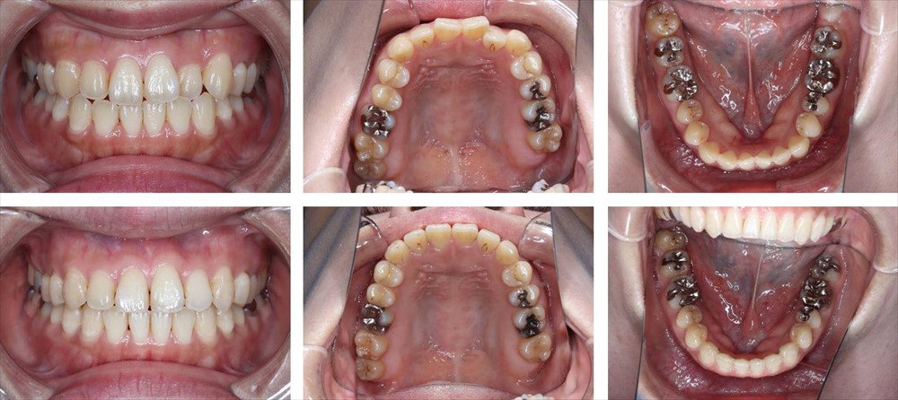 八重歯・叢生の治療例