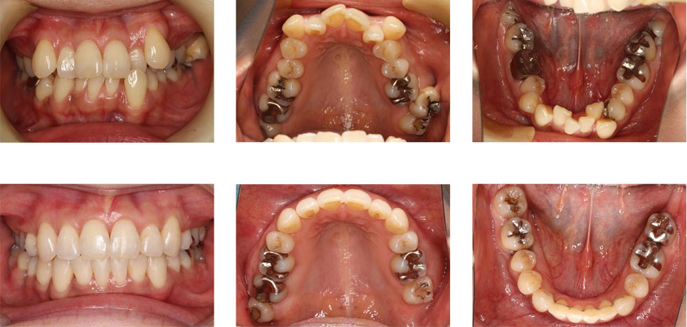 八重歯・叢生の治療例