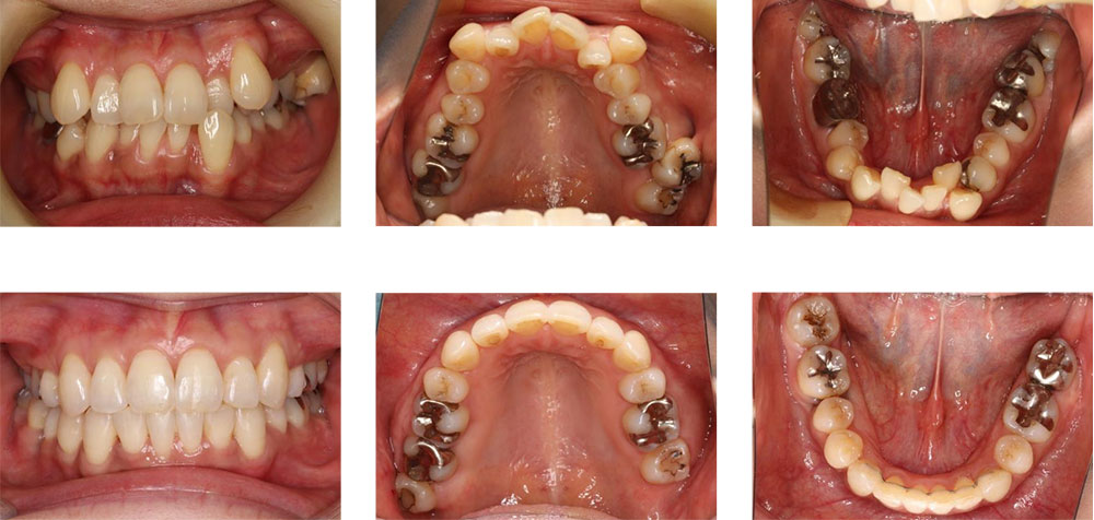 八重歯・叢生（凸凹の歯並び）の治療例
