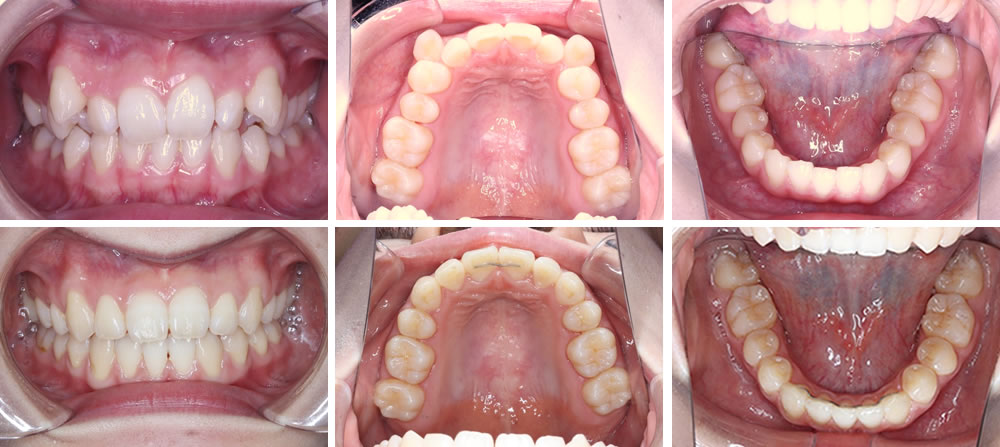 八重歯・叢生の矯正治療例（20代女性 治療期間1年10ヶ月）