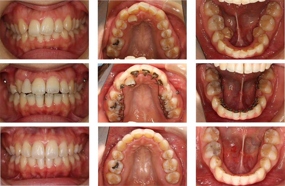 八重歯・叢生の治療例