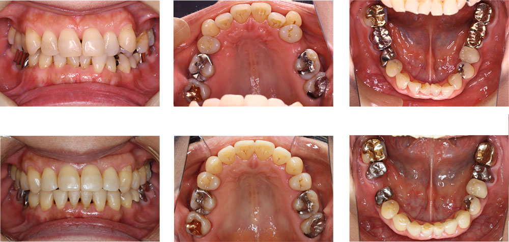 八重歯・叢生の治療例