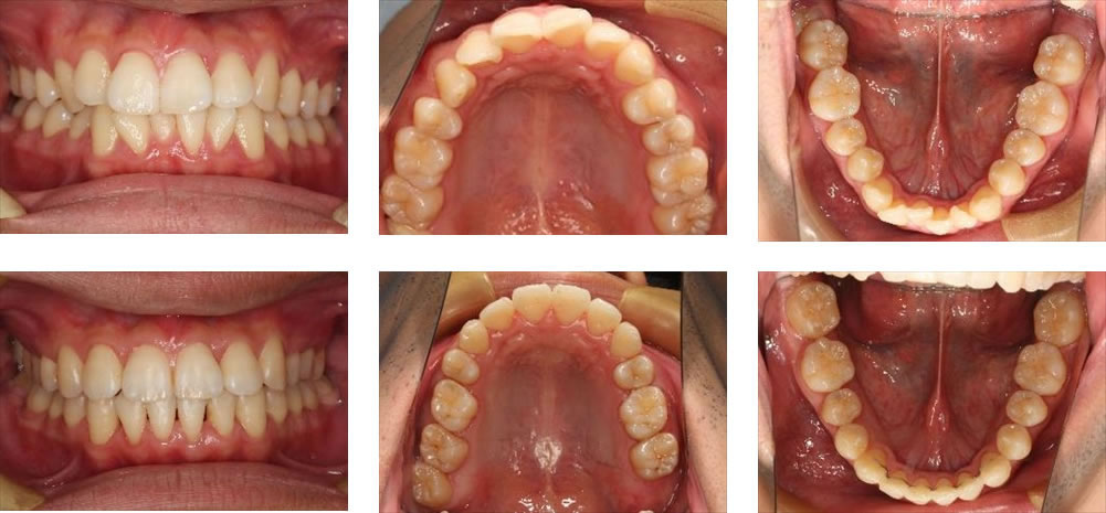 八重歯・叢生の治療例