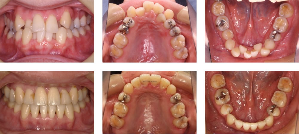 八重歯・叢生の治療例