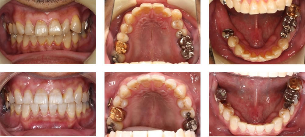 八重歯・叢生の治療例