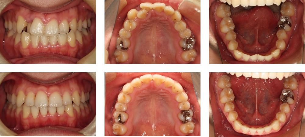 八重歯・叢生の治療例