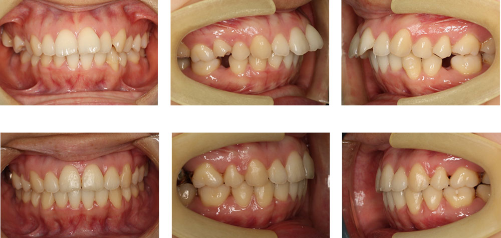 出っ歯（上顎前突）の治療例