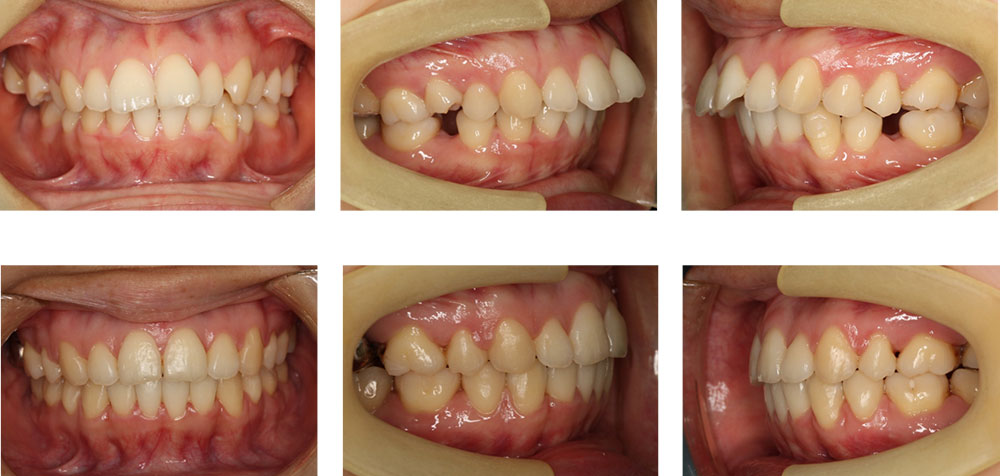 出っ歯 上顎前突 の歯列矯正治療 東京都港区麻布十番のuc矯正歯科