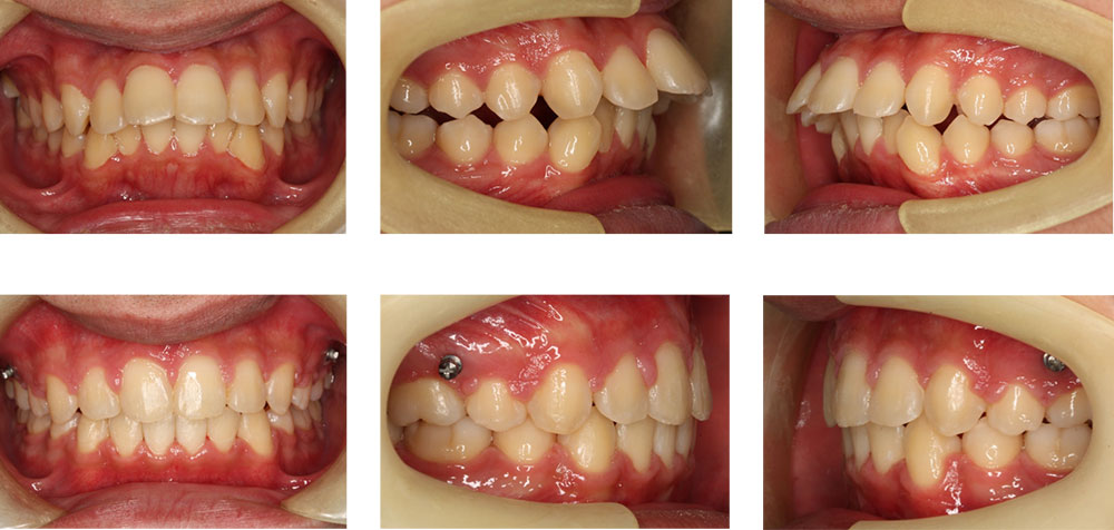 出っ歯の治療例