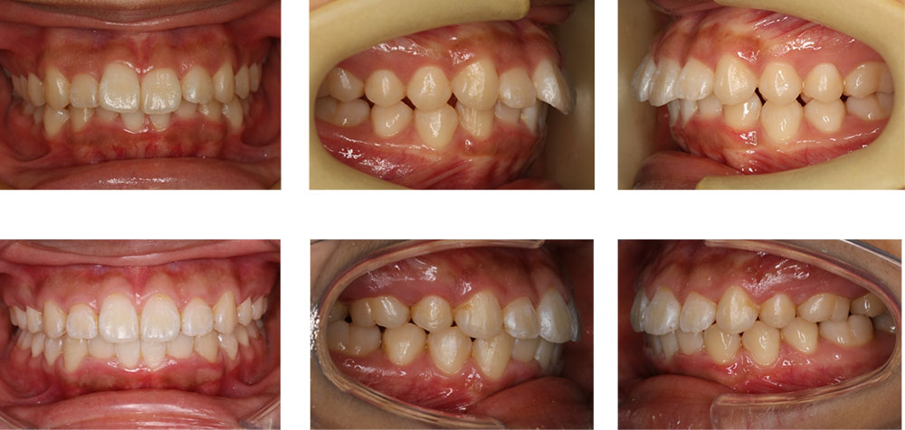 出っ歯の治療例