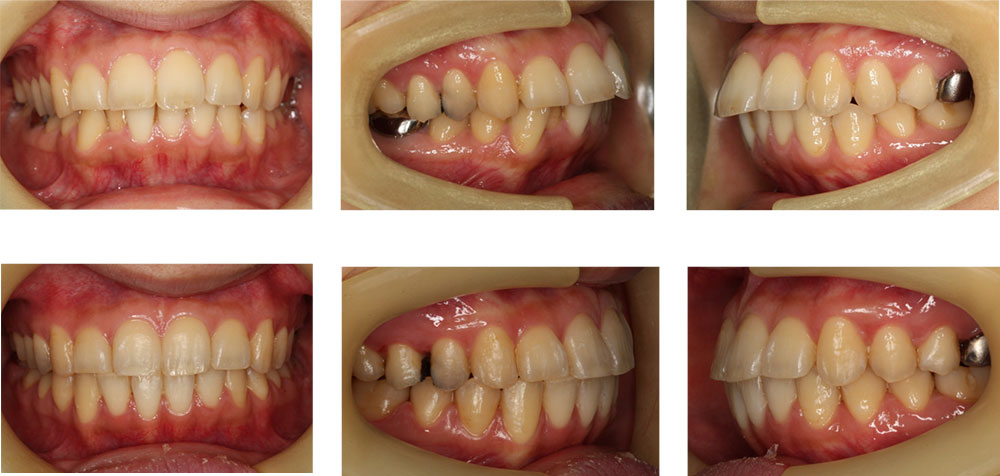 非抜歯矯正の治療例（3０代女性・治療期間3年4ヶ月）