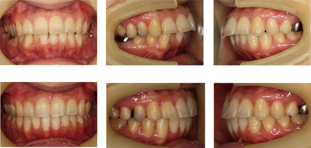 出っ歯の矯正治療例 30代女性 治療期間3年4ヶ月 Uc矯正歯科クリニック麻布十番 東京港区