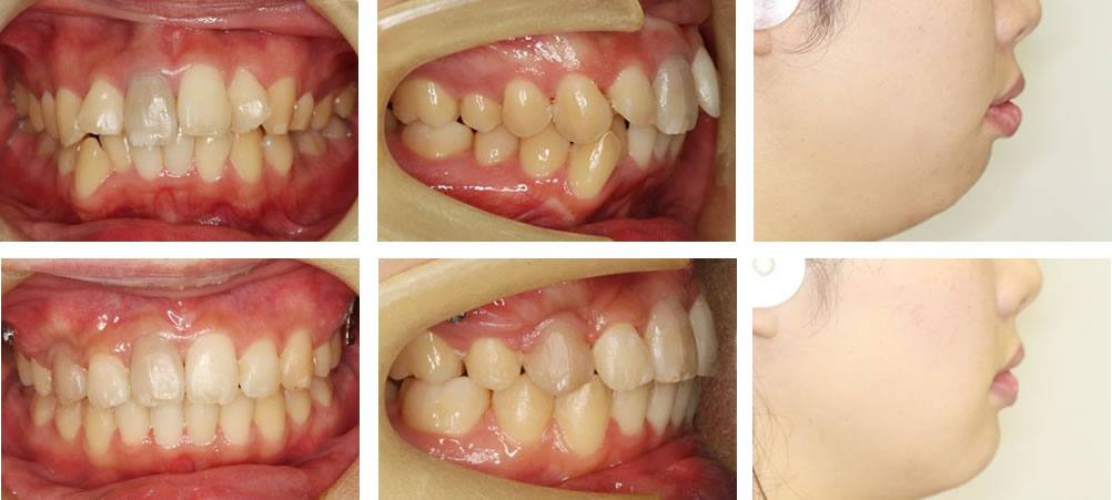 出っ歯の治療例