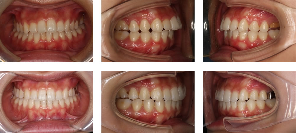 出っ歯の矯正治療例（20代女性 治療期間1年10ヶ月）
