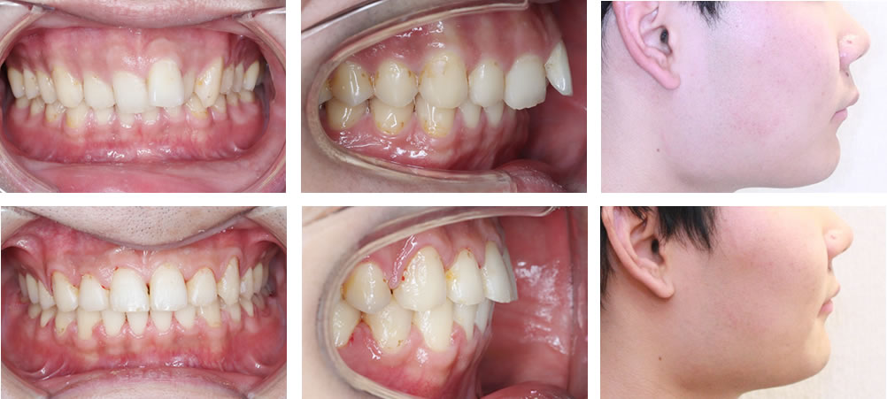 出っ歯の治療例
