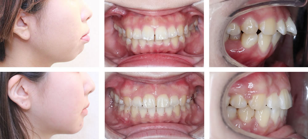 出っ歯の矯正治療例（20代女性 治療期間2年8ヶ月）