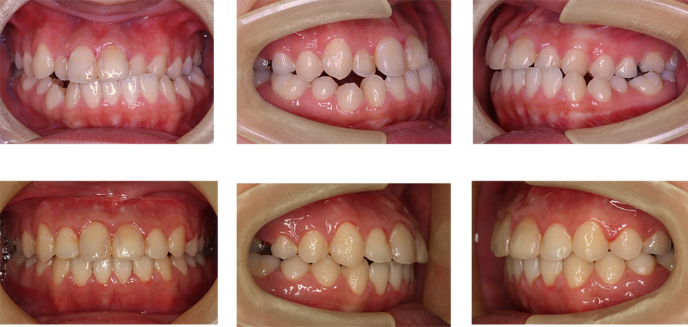 受け口 下顎前突 の歯並び矯正治療 東京都港区麻布十番のuc矯正歯科