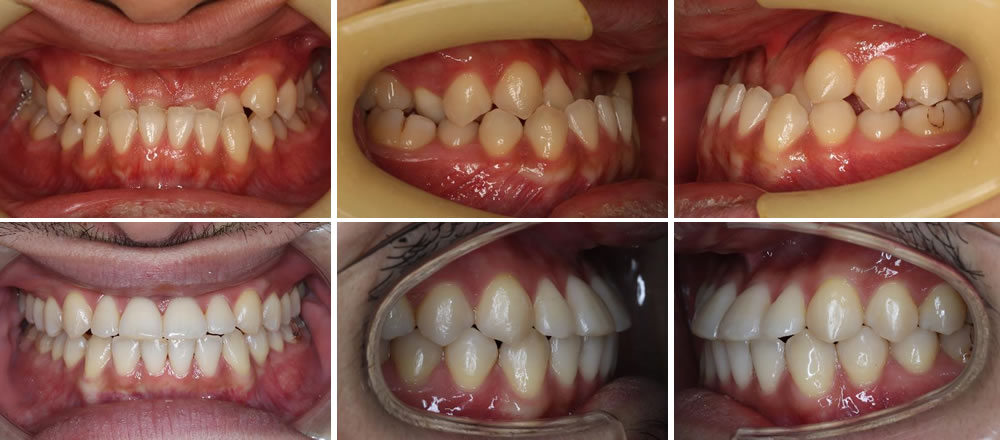 反対咬合の矯正治療例（20代男性 治療期間3年7ヶ月）