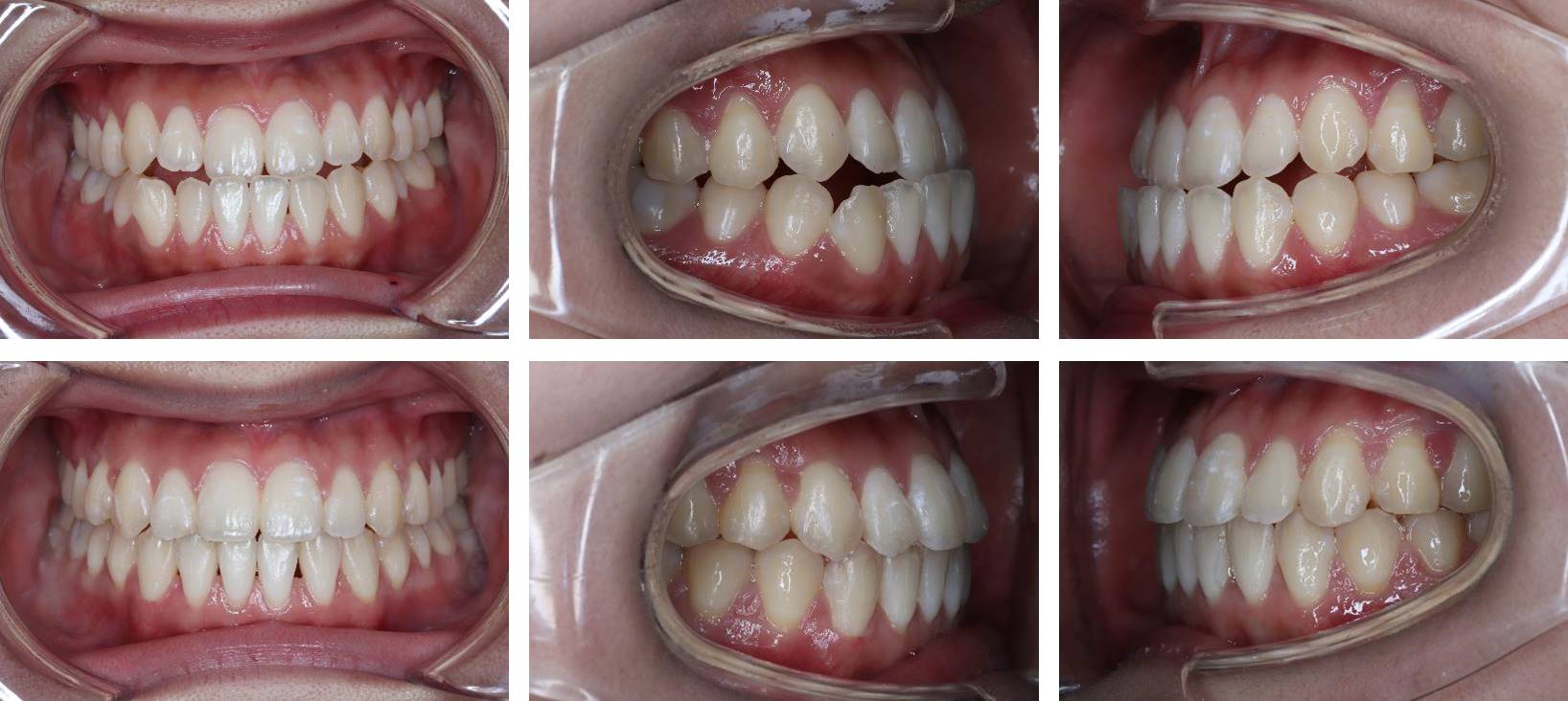 反対咬合の矯正治療例（10代女性 治療期間1年3ヶ月）
