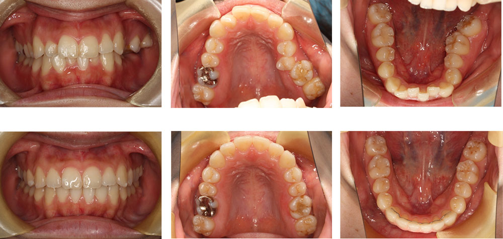 交叉咬合鋏状咬合の治療例