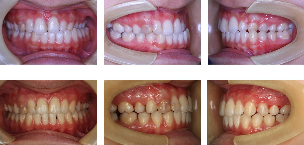 交叉咬合鋏状咬合の治療例