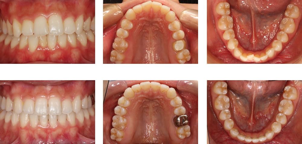 非抜歯矯正の治療例（２０代女性・治療期間1年6ヶ月）