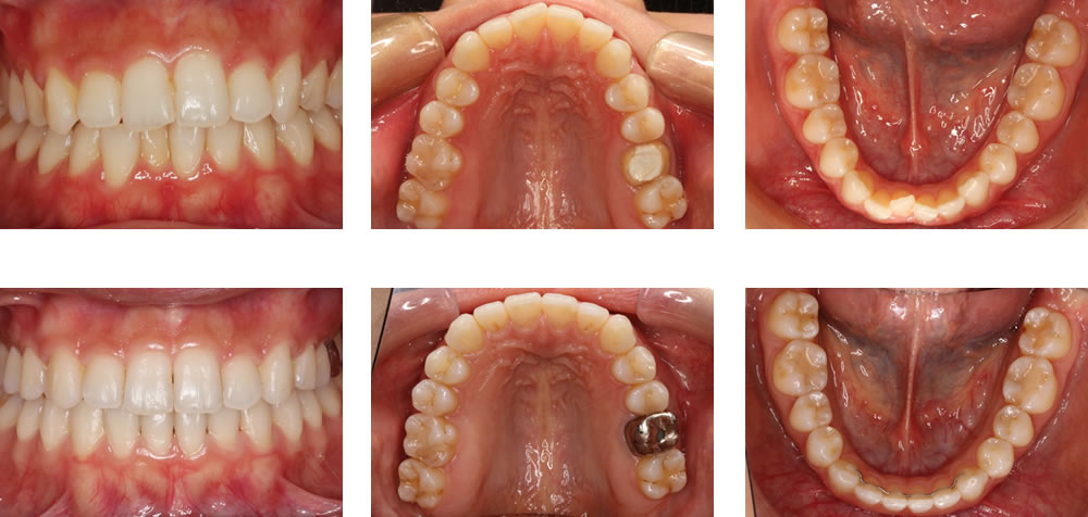 歯を抜かない矯正治療例