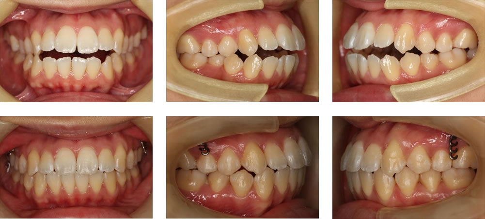 非抜歯矯正の治療例（２０代女性・治療期間3年7ヶ月）