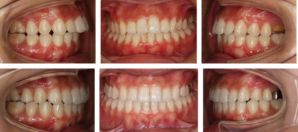 短期間スピード矯正の治療例