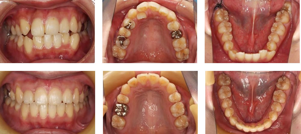 短期間スピード矯正の治療例
