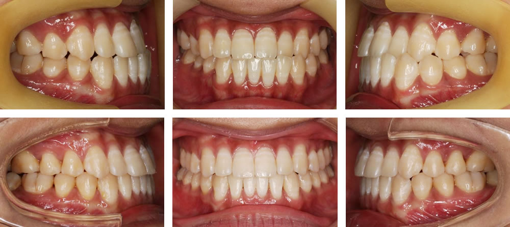 短期間スピード矯正の治療例