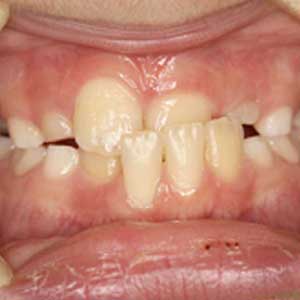 子どもの受け口の歯科矯正治療例