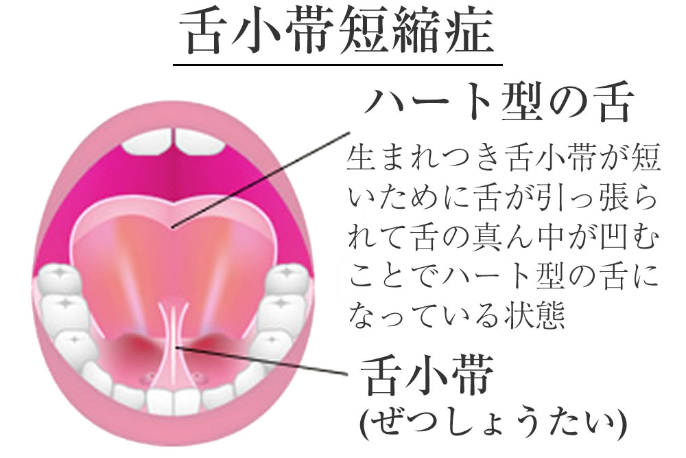 舌小帯短縮症