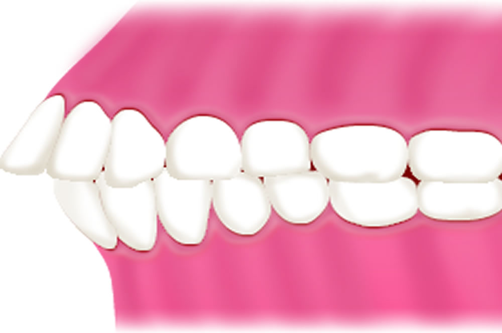 子どもの出っ歯の歯並び矯正治療 東京都港区麻布十番のuc矯正歯科