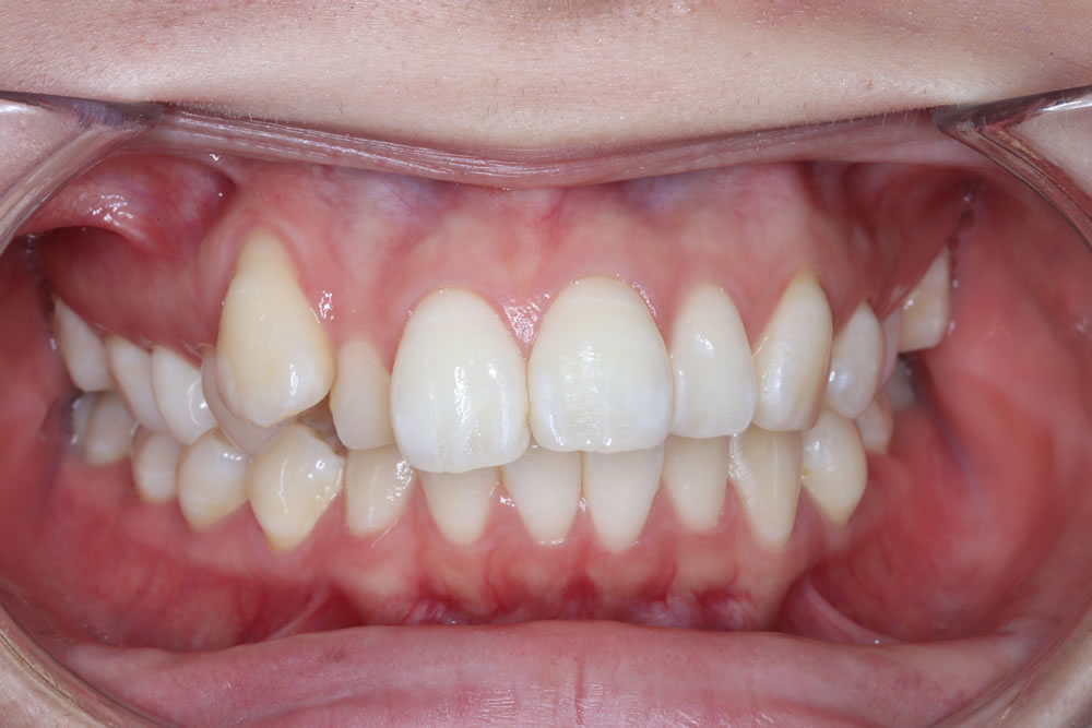 奥歯で咬んだ時の前歯の画像